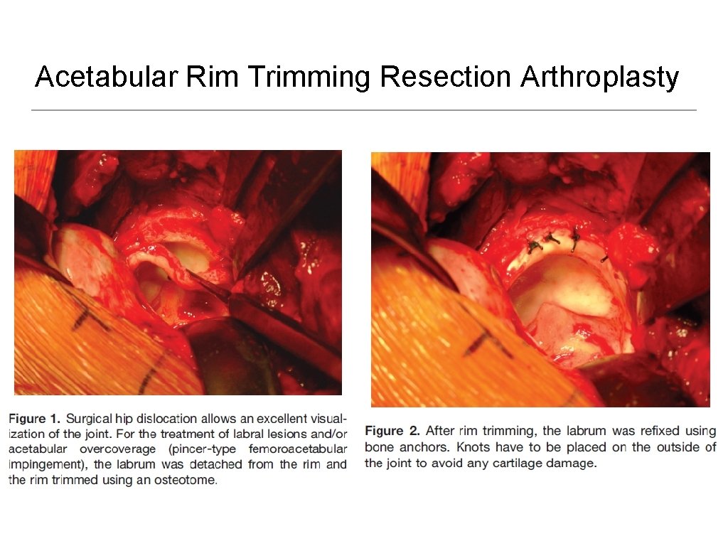 Acetabular Rim Trimming Resection Arthroplasty 