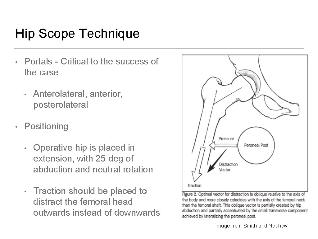 Hip Scope Technique • Portals - Critical to the success of the case •