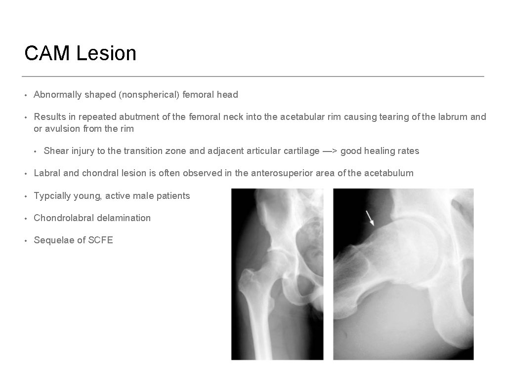 CAM Lesion • Abnormally shaped (nonspherical) femoral head • Results in repeated abutment of