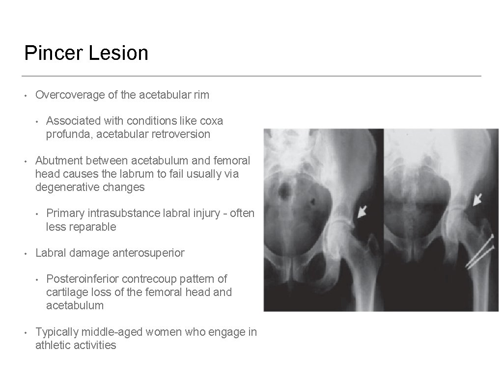 Pincer Lesion • Overcoverage of the acetabular rim • • Abutment between acetabulum and