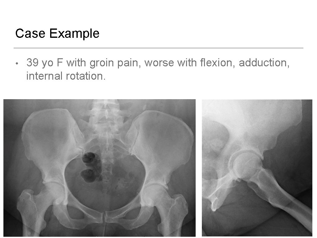 Case Example • 39 yo F with groin pain, worse with flexion, adduction, internal