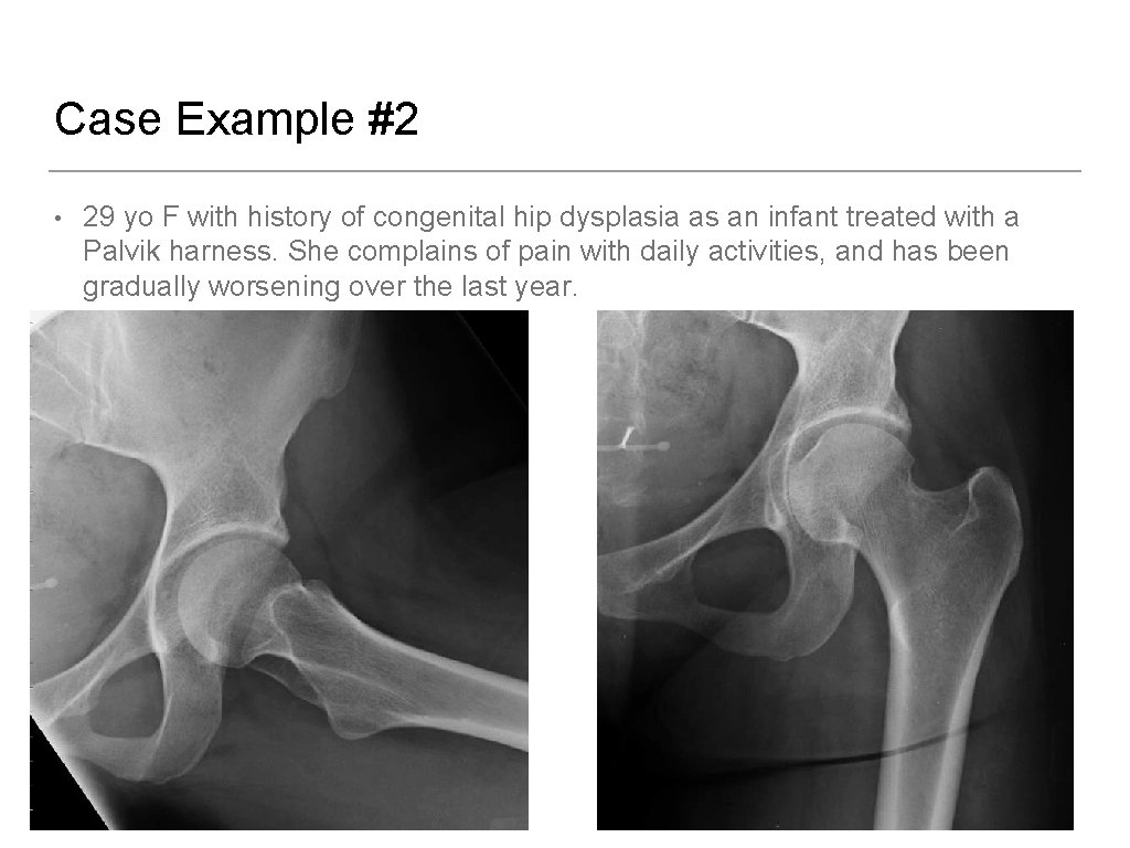 Case Example #2 • 29 yo F with history of congenital hip dysplasia as