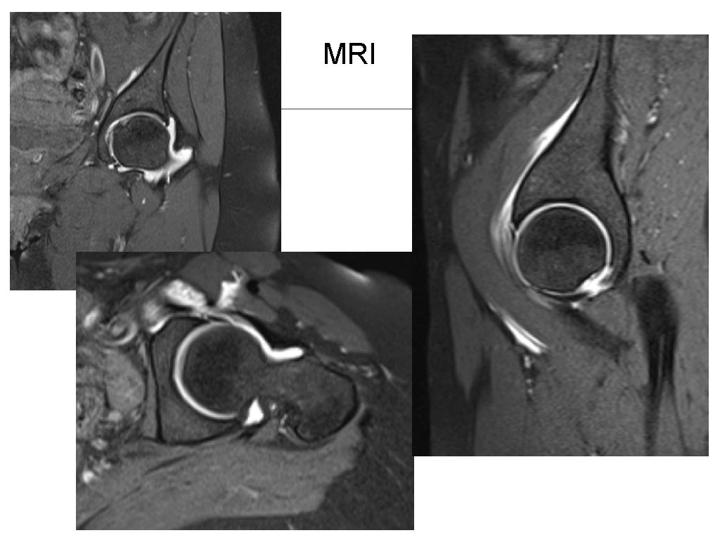 MRI 