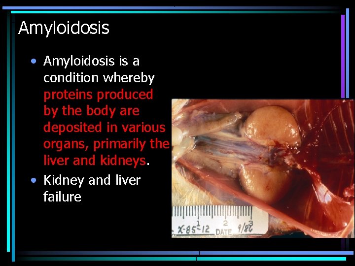 Amyloidosis • Amyloidosis is a condition whereby proteins produced by the body are deposited