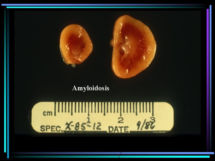 Amyloidosis Amyloidosis