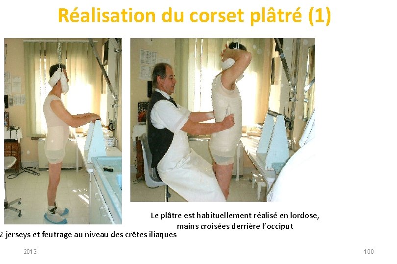 Réalisation du corset plâtré (1) Le plâtre est habituellement réalisé en lordose, mains croisées