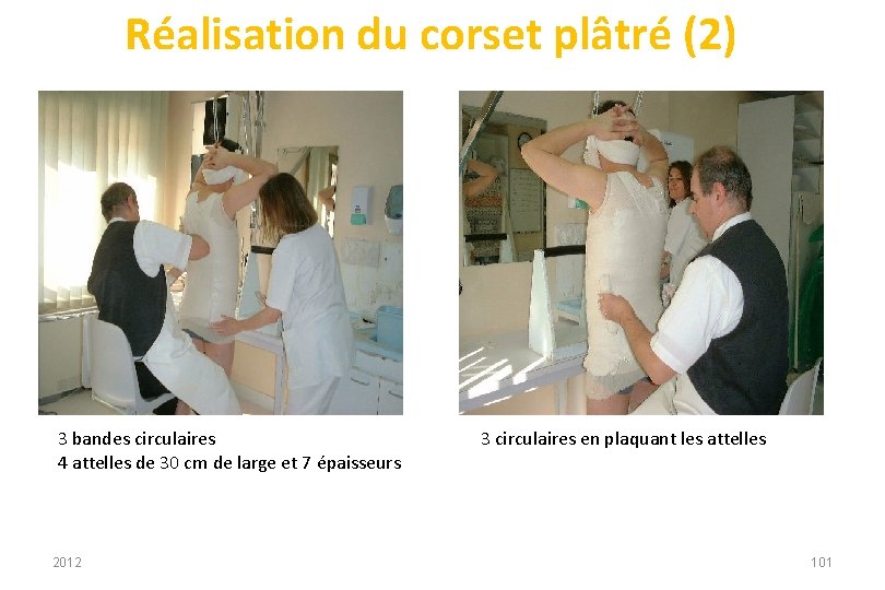 Réalisation du corset plâtré (2) 3 bandes circulaires 4 attelles de 30 cm de