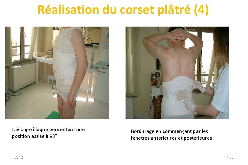 Réalisation du corset plâtré (4) Découpe iliaque permettant une position assise à 90° 2012