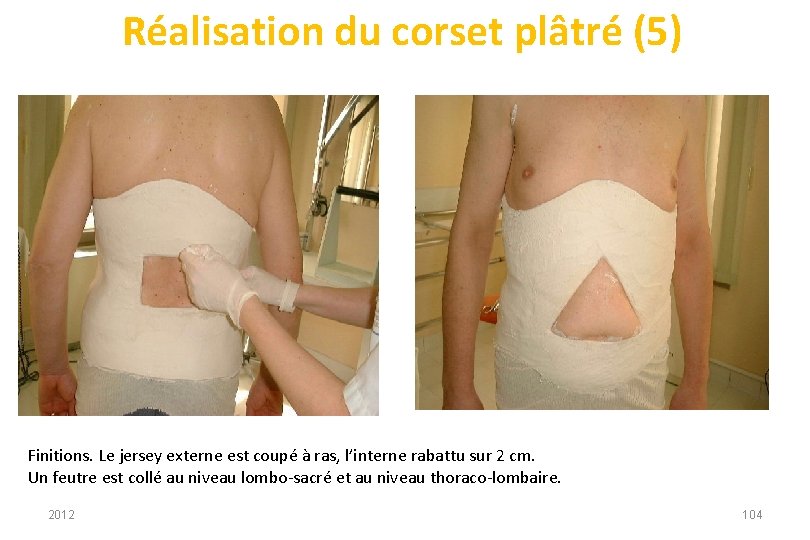 Réalisation du corset plâtré (5) Finitions. Le jersey externe est coupé à ras, l’interne