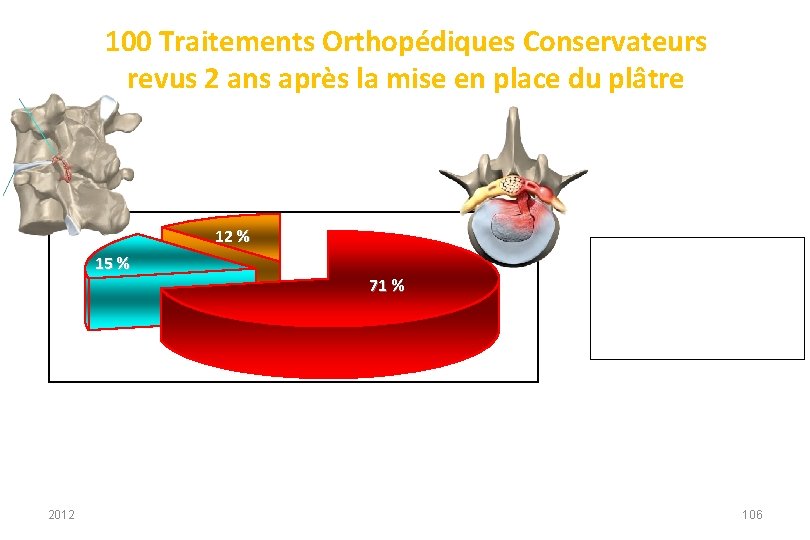 100 Traitements Orthopédiques Conservateurs revus 2 ans après la mise en place du plâtre