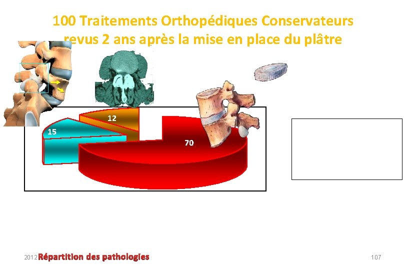 100 Traitements Orthopédiques Conservateurs revus 2 ans après la mise en place du plâtre