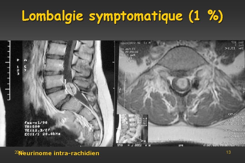 Lombalgie symptomatique (1 %) 2012 Neurinome intra-rachidien 13 