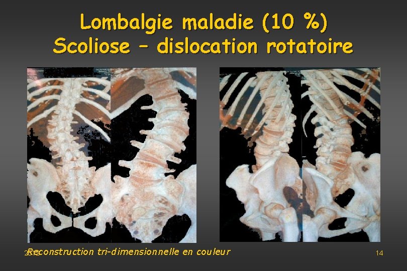 Lombalgie maladie (10 %) Scoliose – dislocation rotatoire Reconstruction 2012 tri-dimensionnelle en couleur 14