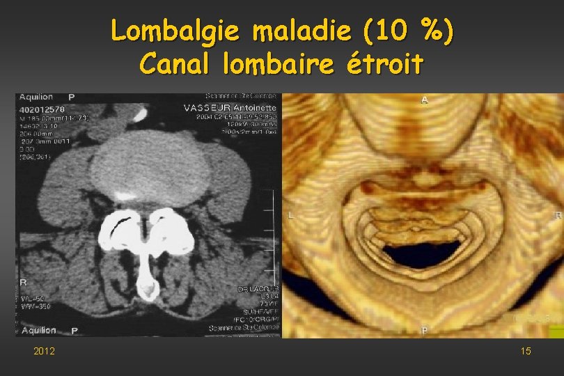 Lombalgie maladie (10 %) Canal lombaire étroit 2012 15 