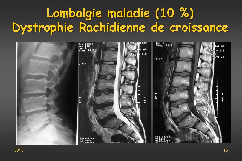 Lombalgie maladie (10 %) Dystrophie Rachidienne de croissance 2012 16 