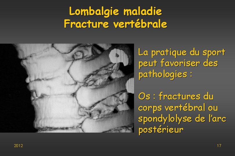 Lombalgie maladie Fracture vertébrale La pratique du sport peut favoriser des pathologies : Os