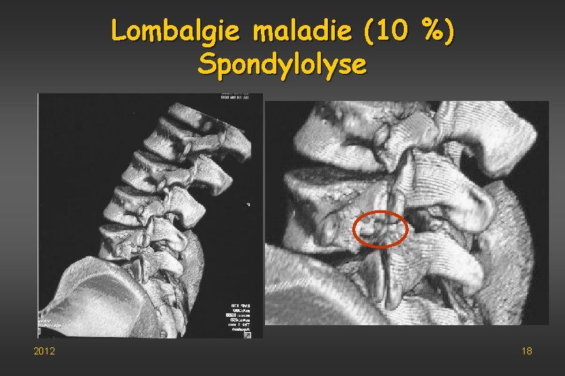 Lombalgie maladie (10 %) Spondylolyse 2012 18 