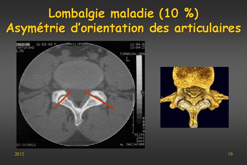 Lombalgie maladie (10 %) Asymétrie d’orientation des articulaires 2012 19 