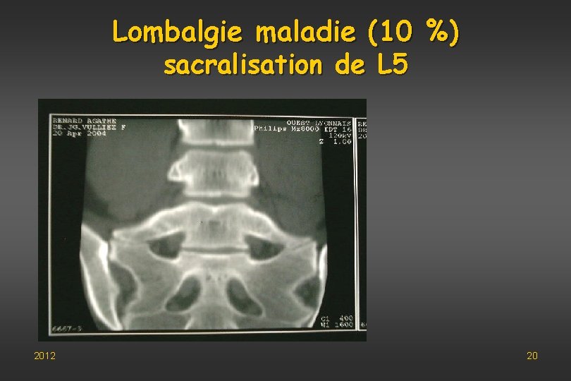 Lombalgie maladie (10 %) sacralisation de L 5 2012 20 