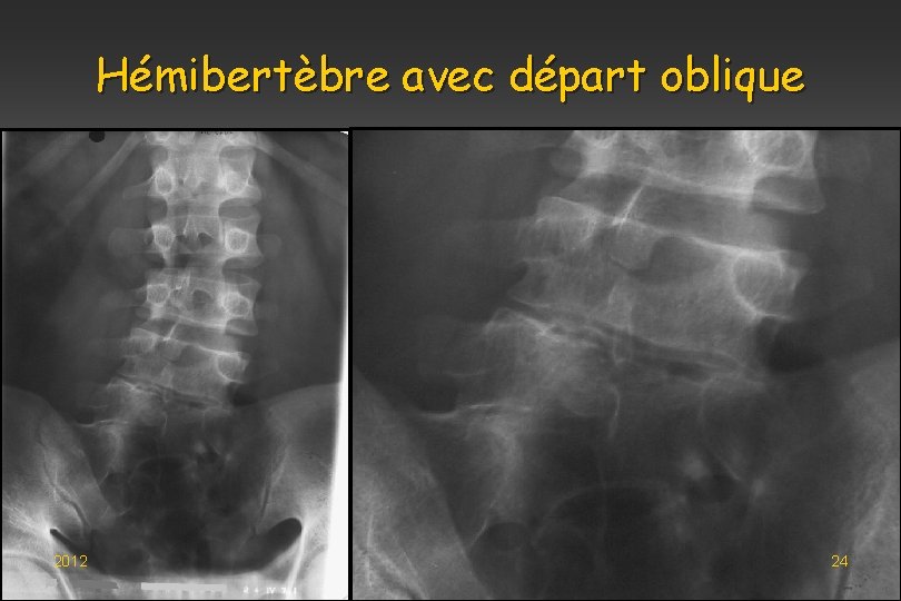 Hémibertèbre avec départ oblique 2012 24 