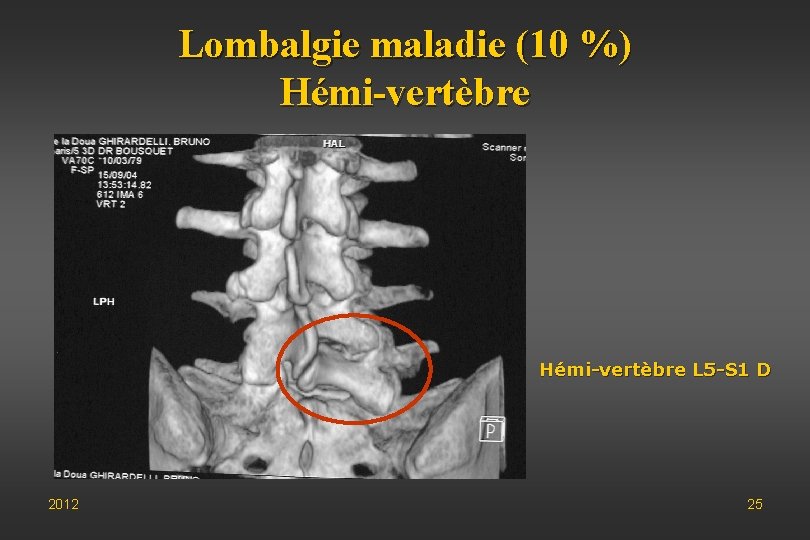 Lombalgie maladie (10 %) Hémi-vertèbre L 5 -S 1 D 2012 25 