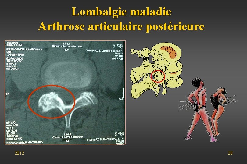Lombalgie maladie Arthrose articulaire postérieure 2012 28 