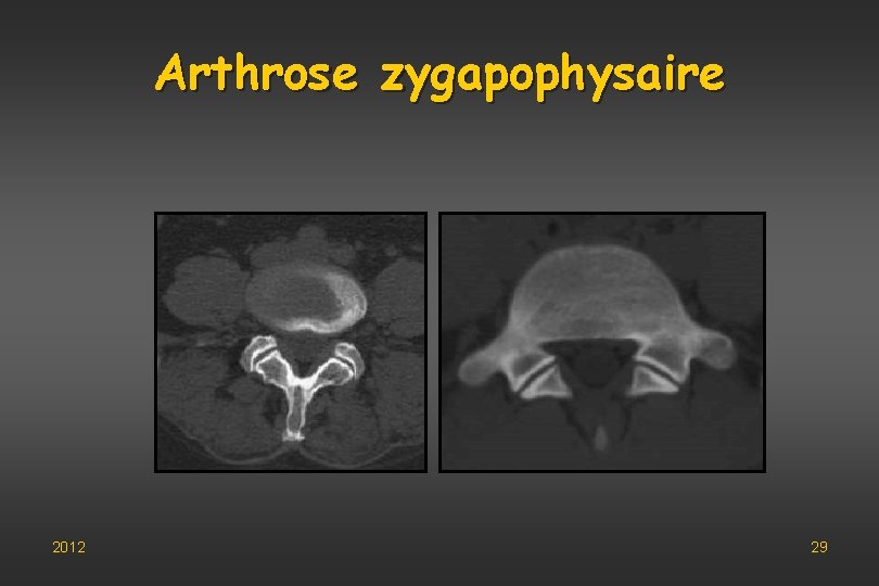 Arthrose zygapophysaire 2012 29 