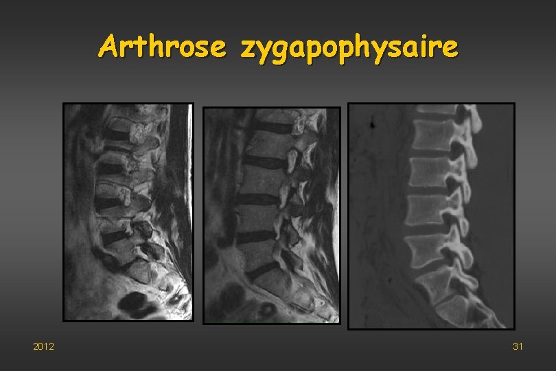 Arthrose zygapophysaire 2012 31 