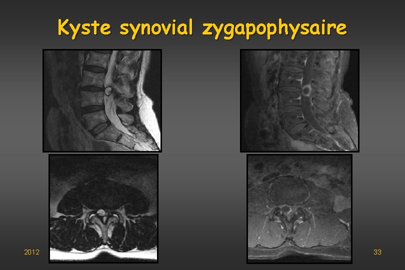 Kyste synovial zygapophysaire 2012 33 