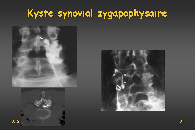 Kyste synovial zygapophysaire 2012 34 