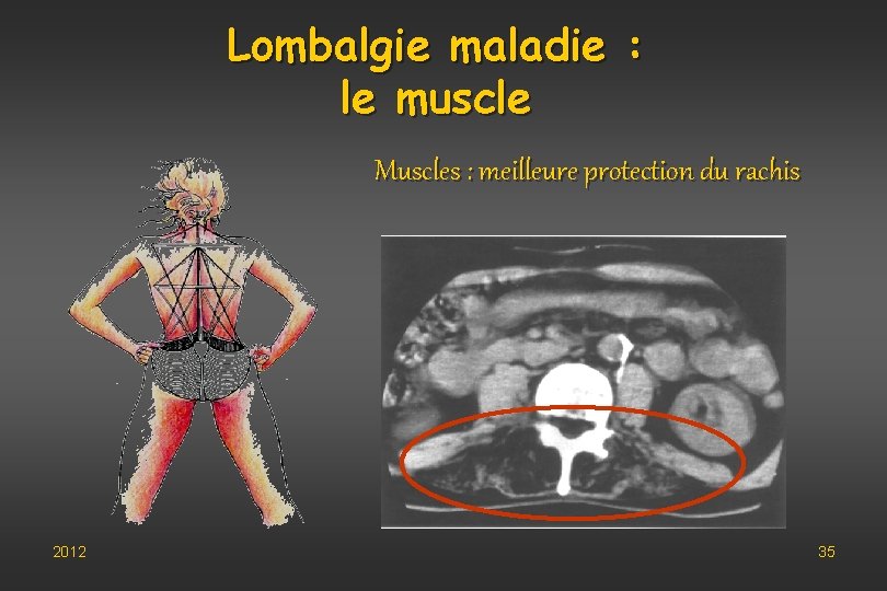 Lombalgie maladie : le muscle Muscles : meilleure protection du rachis 2012 35 