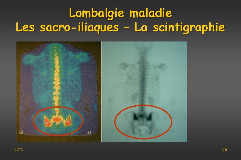 Lombalgie maladie Les sacro-iliaques – La scintigraphie 2012 36 