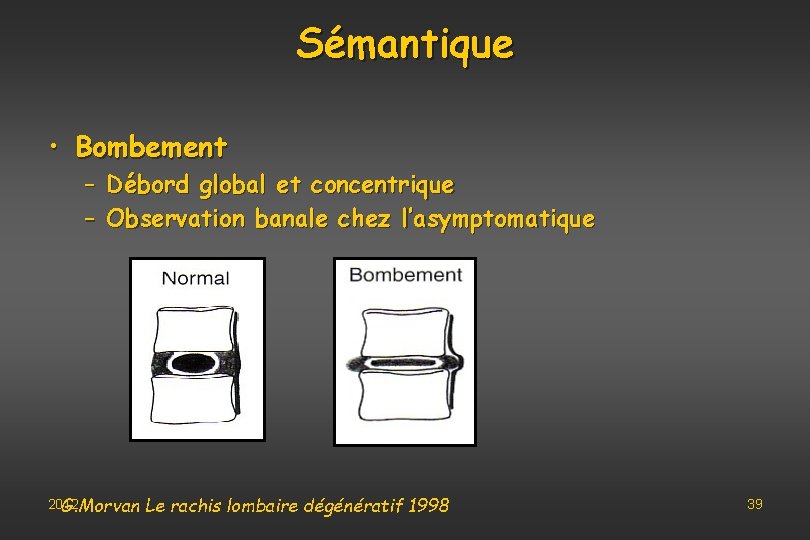 Sémantique • Bombement – Débord global et concentrique – Observation banale chez l’asymptomatique 2012