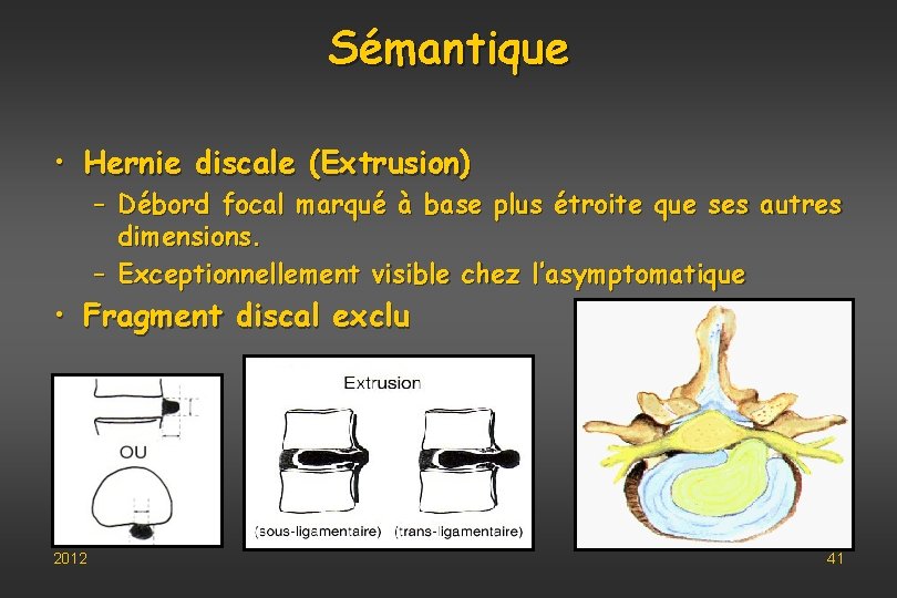 Sémantique • Hernie discale (Extrusion) – Débord focal marqué à base plus étroite que