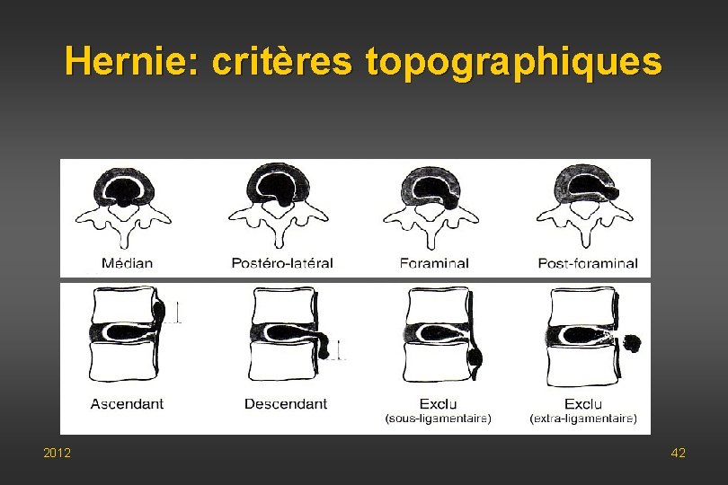 Hernie: critères topographiques 2012 42 