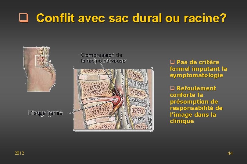 q Conflit avec sac dural ou racine? q Pas de critère formel imputant la