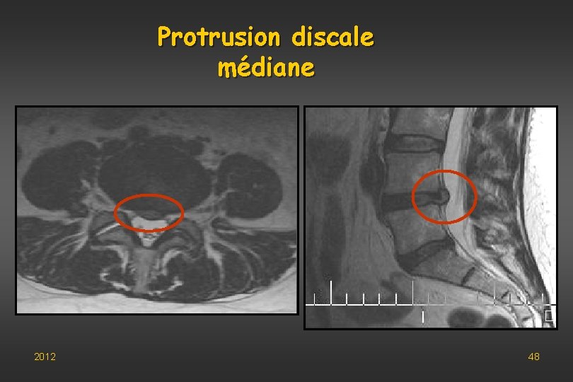 Protrusion discale médiane 2012 48 