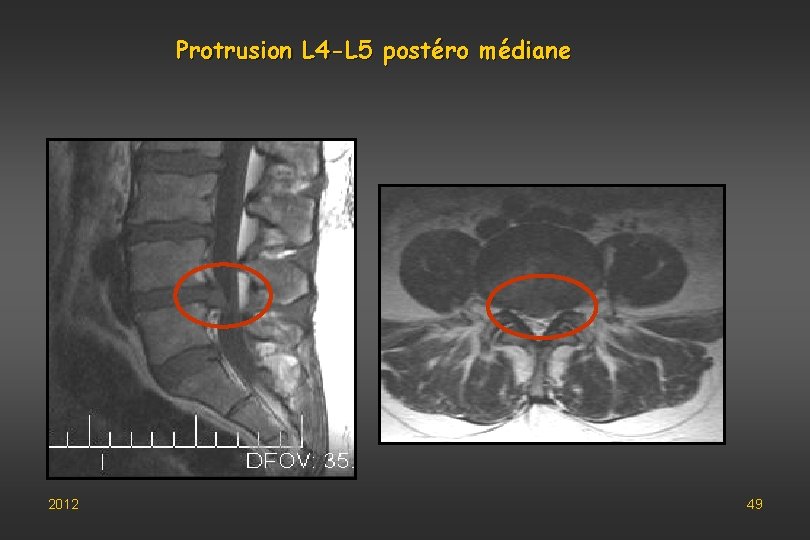 Protrusion L 4 -L 5 postéro médiane 2012 49 