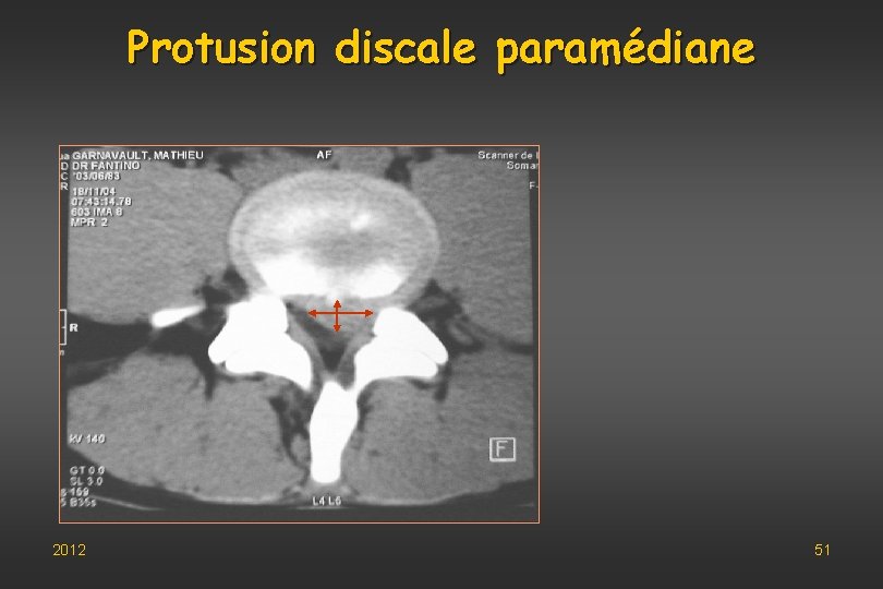 Protusion discale paramédiane 2012 51 