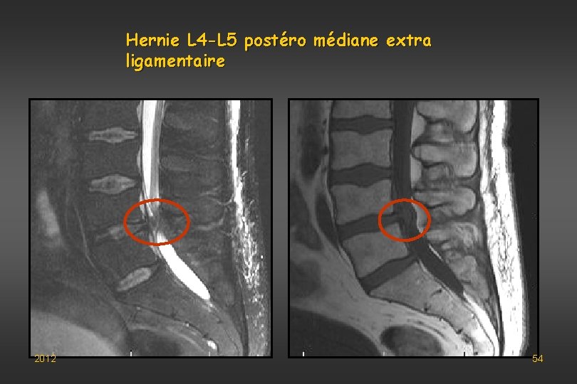 Hernie L 4 -L 5 postéro médiane extra ligamentaire 2012 54 