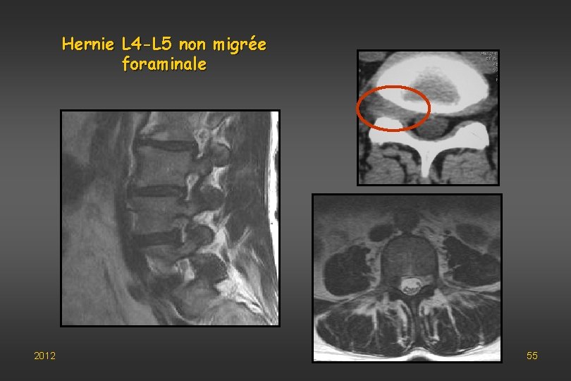 Hernie L 4 -L 5 non migrée foraminale 2012 55 