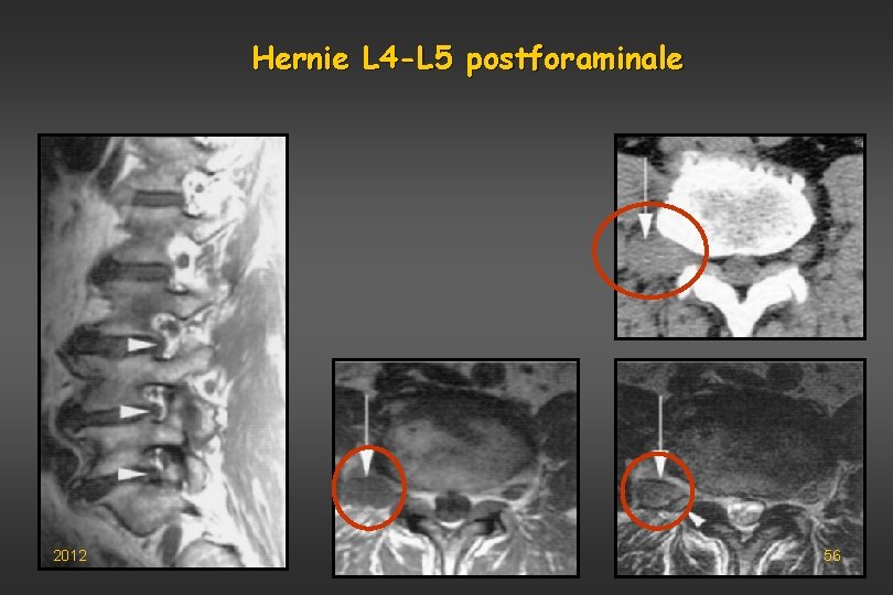 Hernie L 4 -L 5 postforaminale 2012 56 