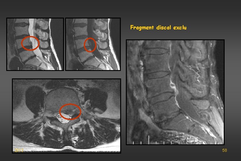 Fragment discal exclu 2012 58 