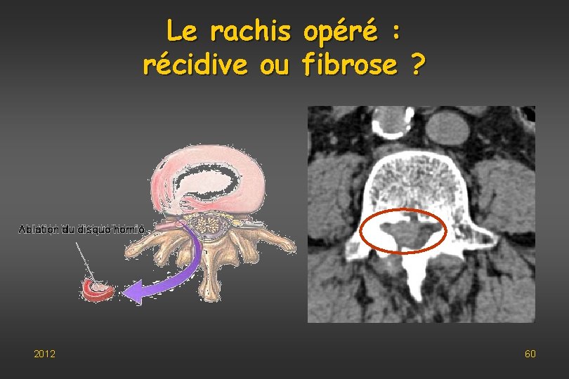 Le rachis opéré : récidive ou fibrose ? 2012 60 