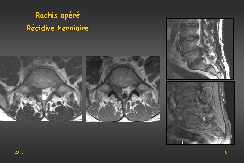 Rachis opéré Récidive herniaire 2012 61 