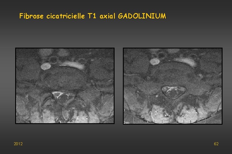 Fibrose cicatricielle T 1 axial GADOLINIUM 2012 62 