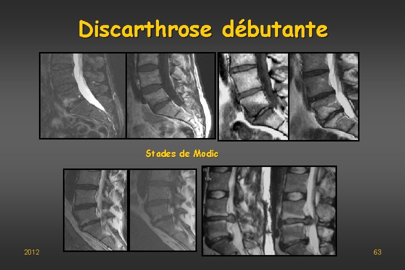 Discarthrose débutante Stades de Modic 2012 63 