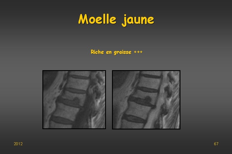 Moelle jaune Riche en graisse +++ 2012 67 