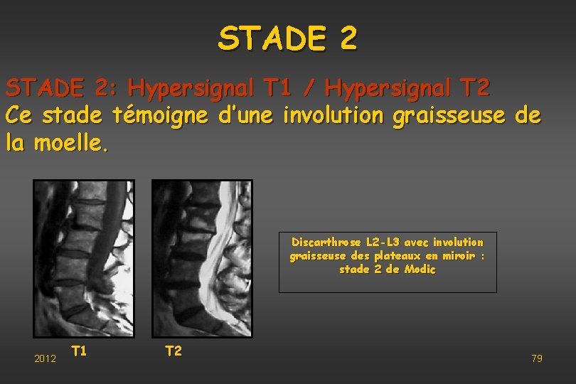 STADE 2: Hypersignal T 1 / Hypersignal T 2 Ce stade témoigne d’une involution