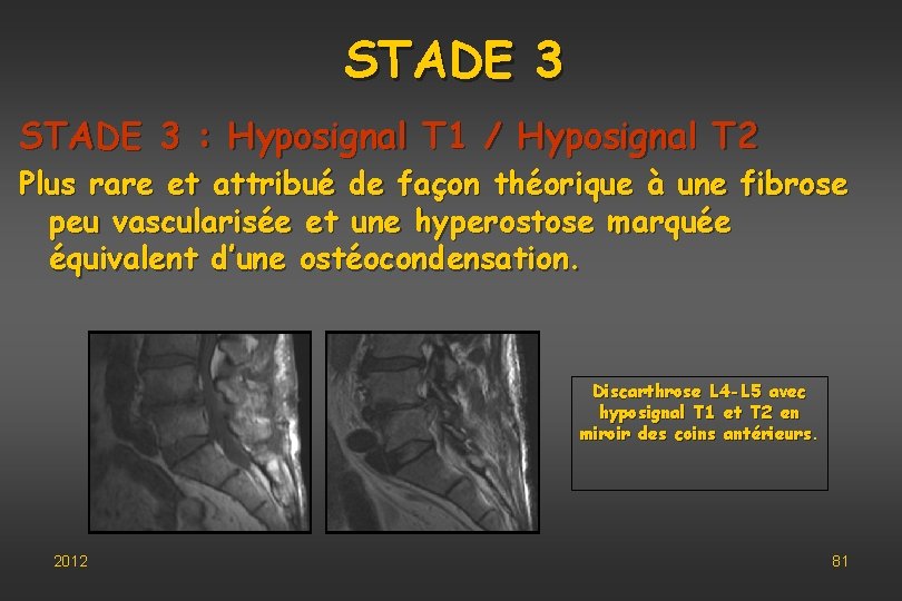 STADE 3 : Hyposignal T 1 / Hyposignal T 2 Plus rare et attribué